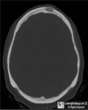 Dermoid Cyst of Skull